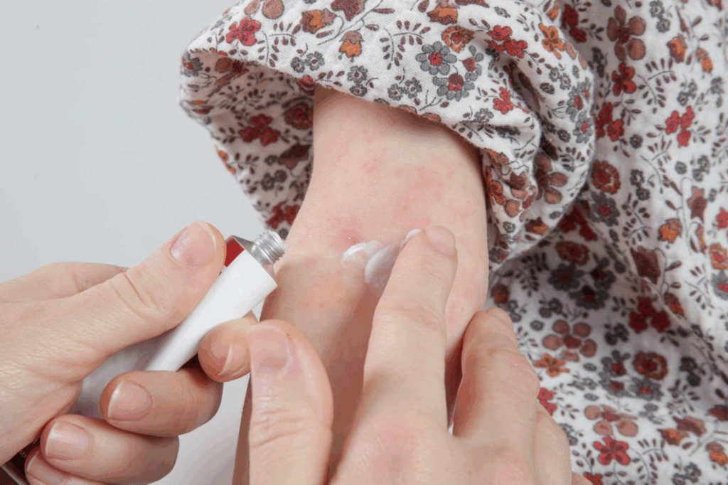 アトピーのお薬は何を選ぶ?タイプ別選び方とみんなのリアルな体験談